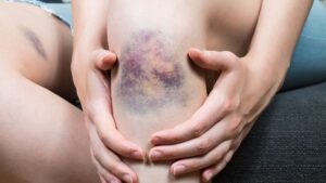 چرا بدن بدون دلیل کبود می شود؟